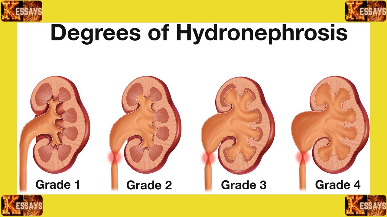 Hydronephrosis Causes